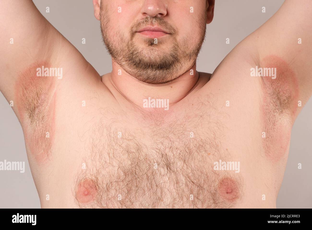 Arrossamento delle ascelle in un uomo - infiammazione o calore pungente, macchie rosse delle ascelle. Foto Stock