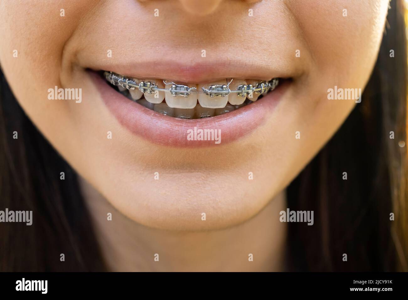 Bella ragazza sorridente che mostra fermo, bretelle per denti. Ortodonzia tema dentistico, metodi di correzione dell'aquilone dei denti, primo piano Foto Stock