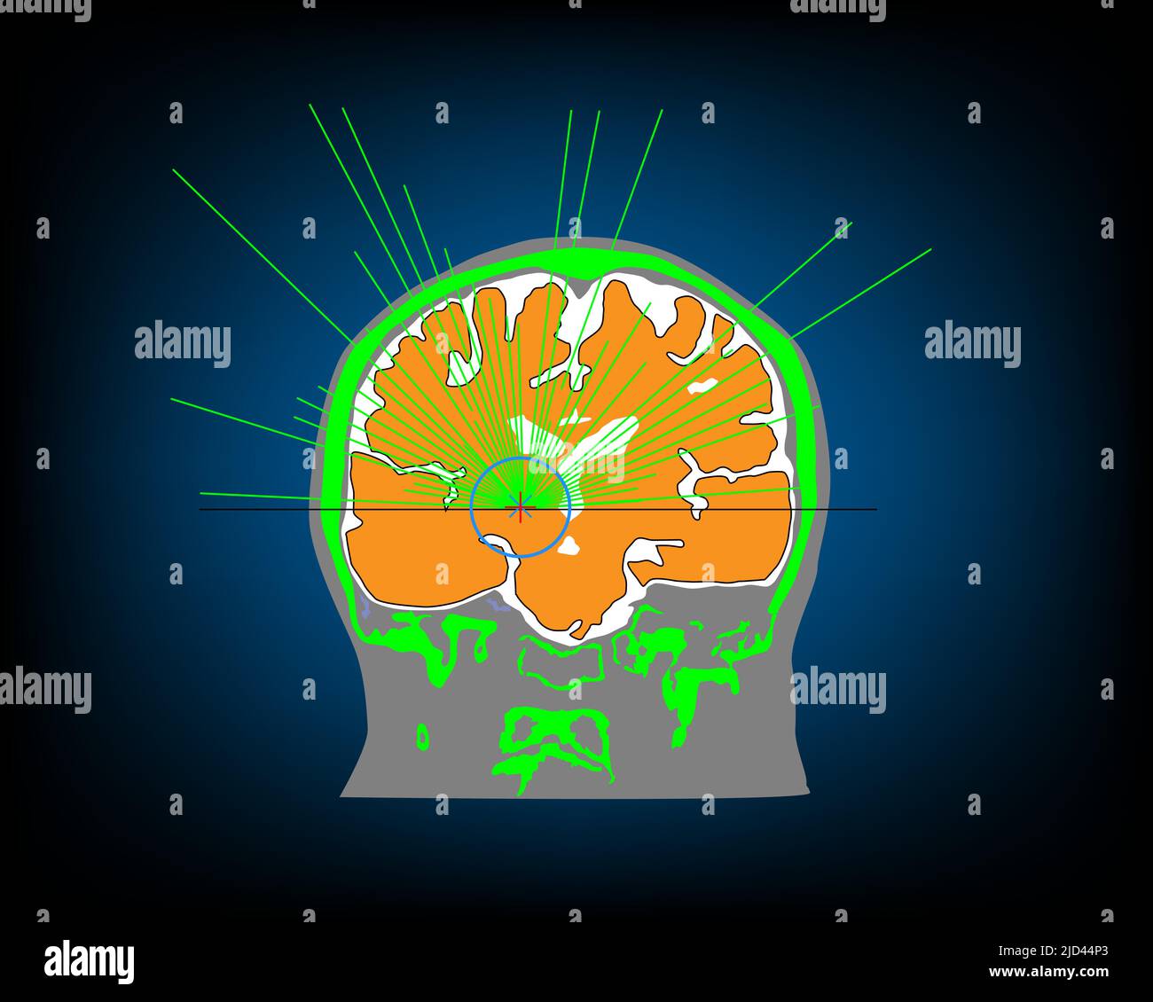 Illustrazione dell'ecografia focalizzata guidata da risonanza magnetica (MRgFUS) al talamo (VIM) per il monitoraggio del tremore essenziale. Illustrazione Vettoriale