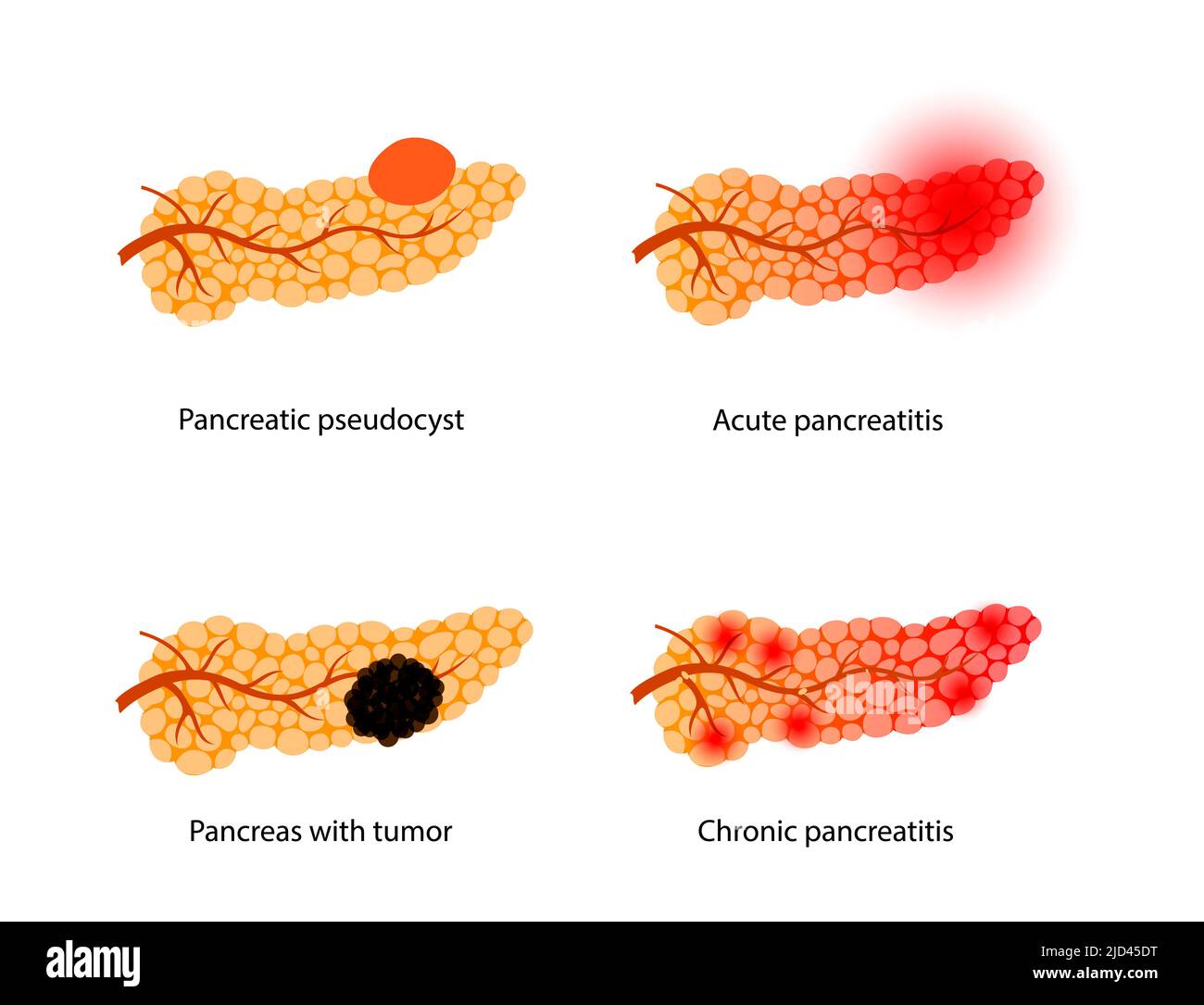 Malattie pancreatiche, illustrazione Foto Stock