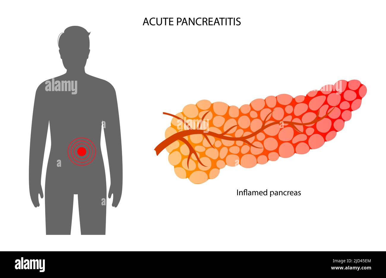 Pancreatite acuta, illustrazione Foto Stock