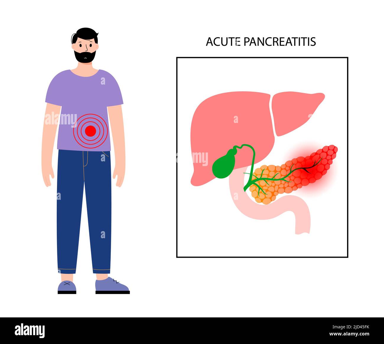 Pancreatite acuta, illustrazione Foto Stock