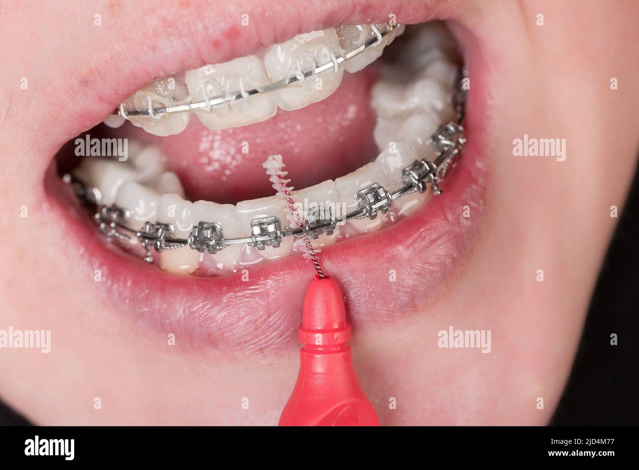 Scovolino dentale immagini e fotografie stock ad alta risoluzione - Alamy