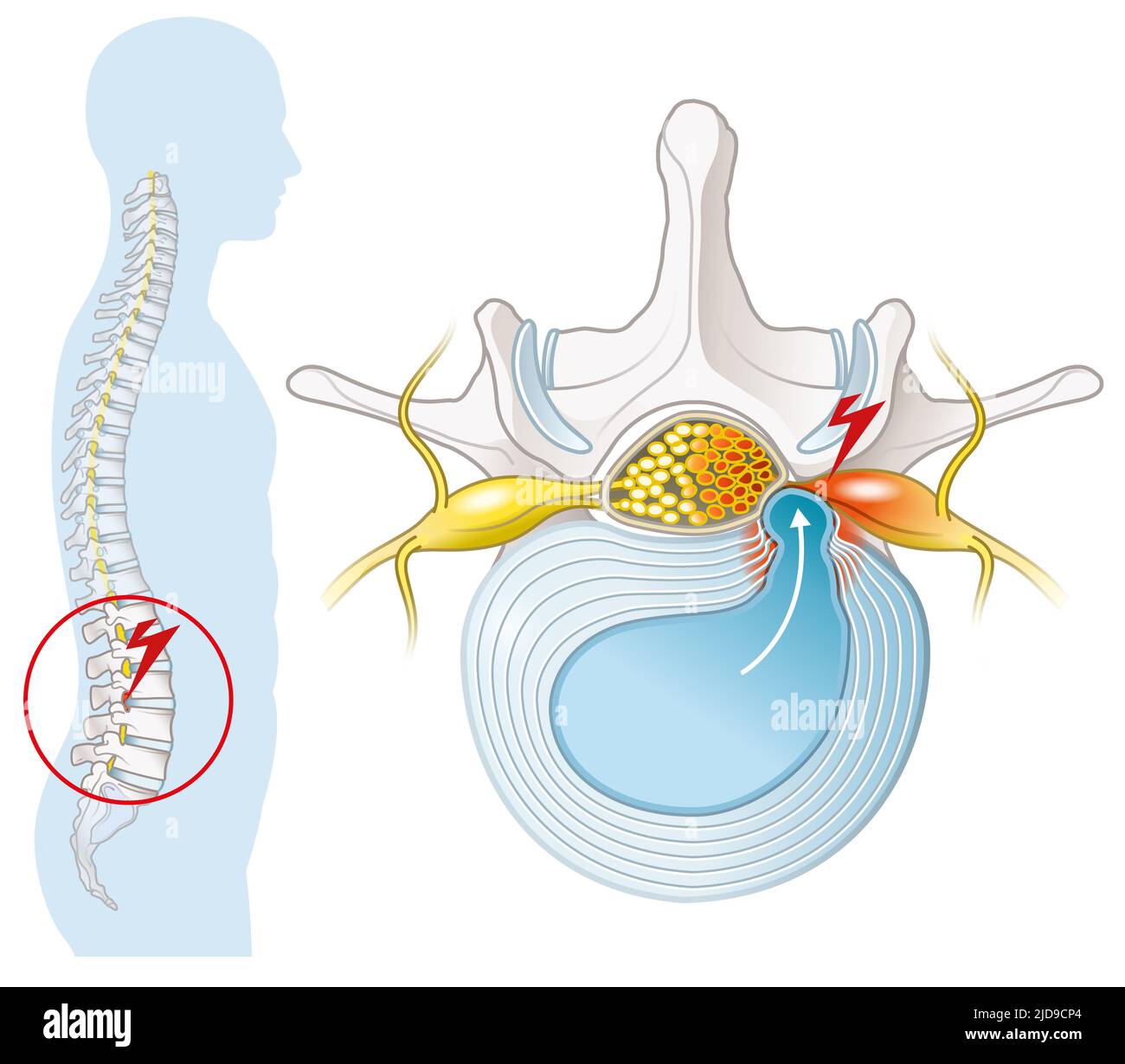 Illustrazione che mostra la vertebra lombare con disco intervertebrale e nucleo erniato pulposo Foto Stock