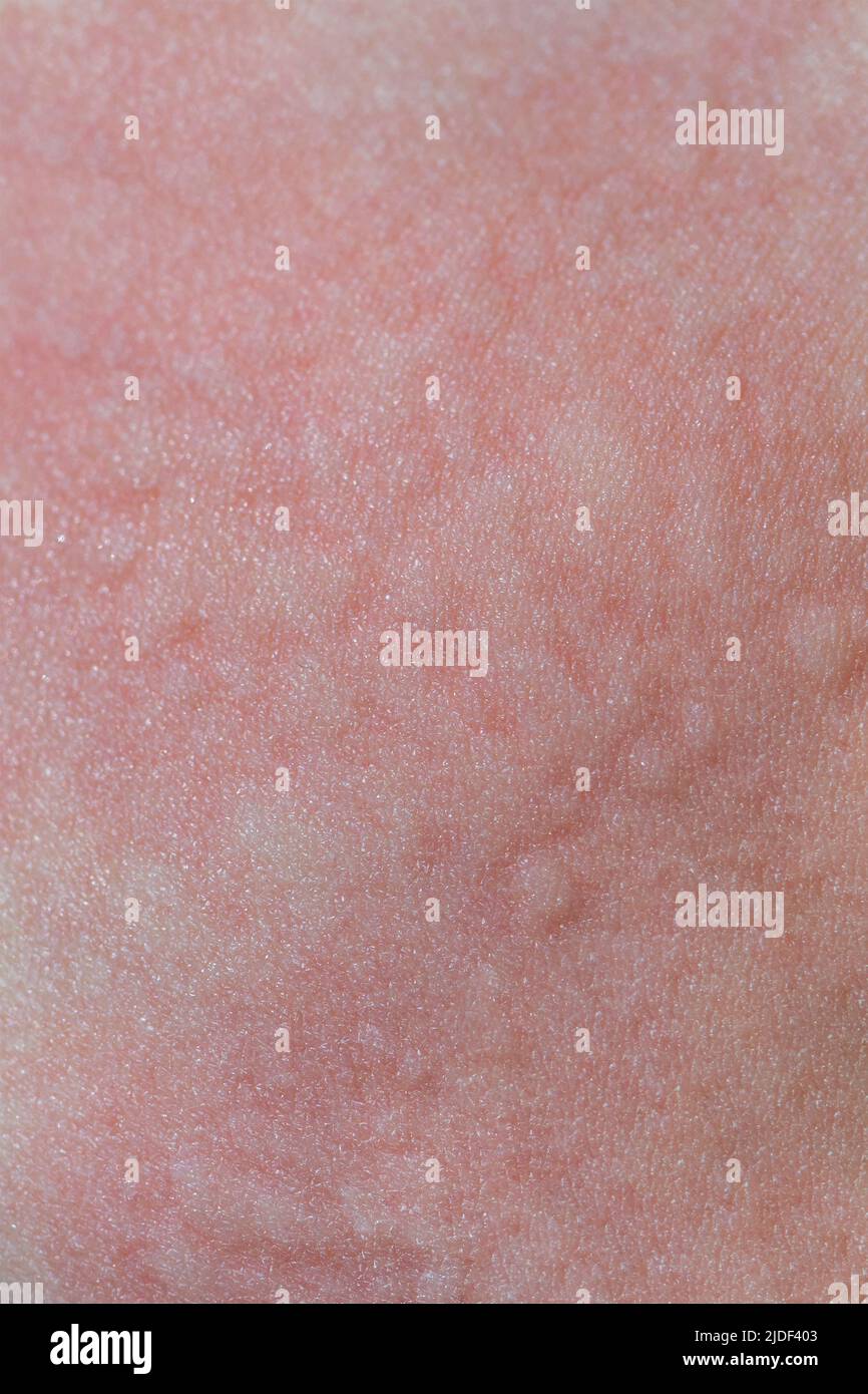 Orticaria sulla pelle. Macchie rosse di una reazione allergica sulla