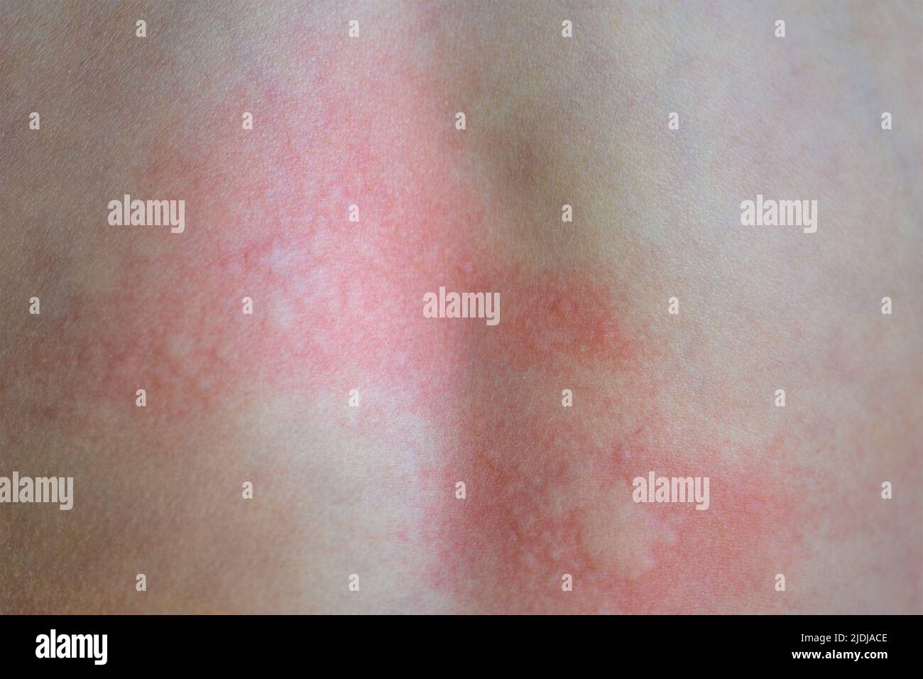 Orticaria sulla pelle. Macchie rosse di una reazione allergica sulla