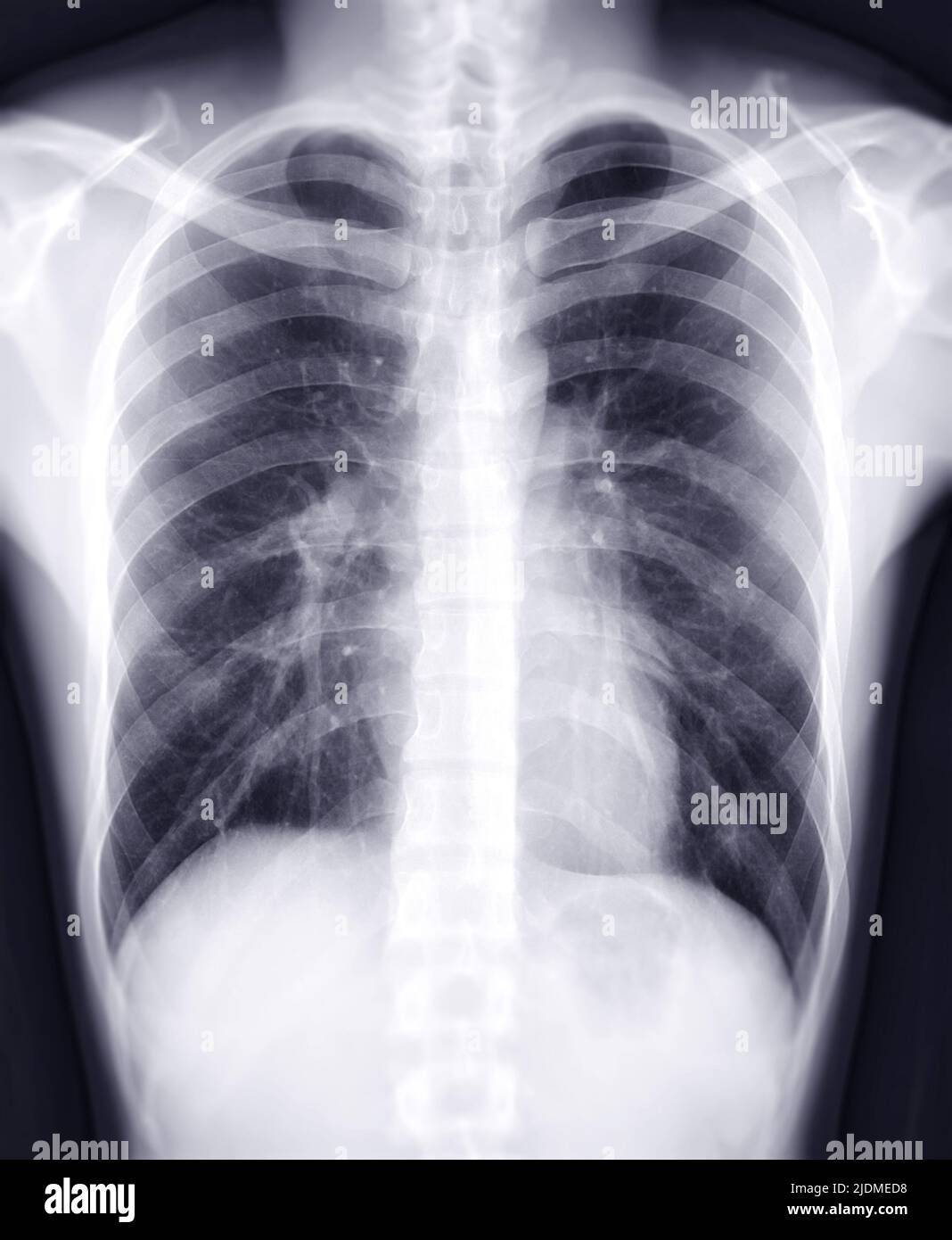 Immagine radiologica toracica per diagnosi di screening TB,tuberculosis e covid-19. Foto Stock