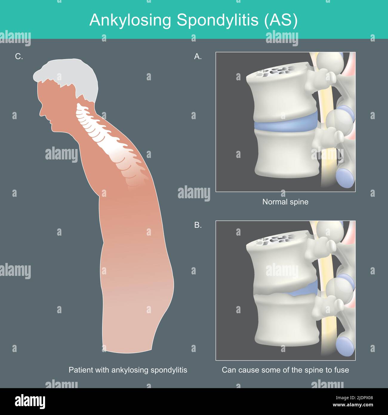 Spondilite anchilosante. Deformità della colonna umana dovute all'infiammazione e possono causare la fusione di alcune delle spine. Illustrazione Vettoriale