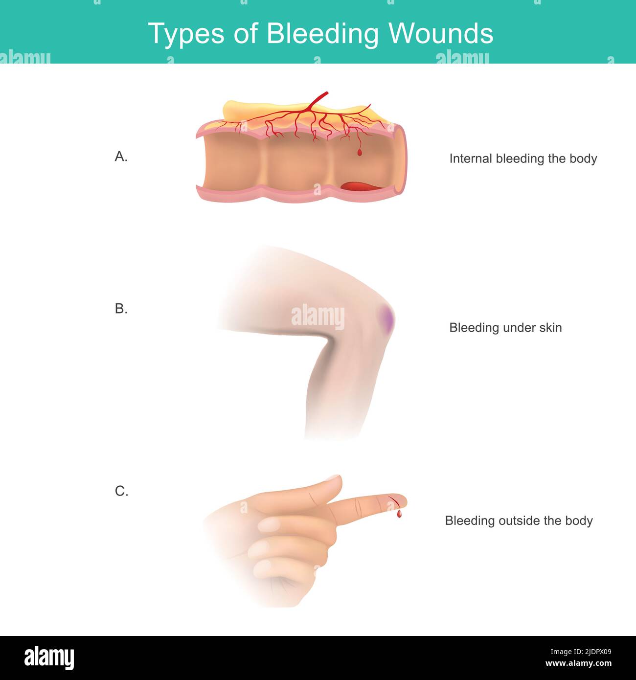 Tipi di ferite da sanguinamento. Il sanguinamento è la perdita di sangue, all'interno o all'esterno del corpo. Infografica illustrativa. Illustrazione Vettoriale