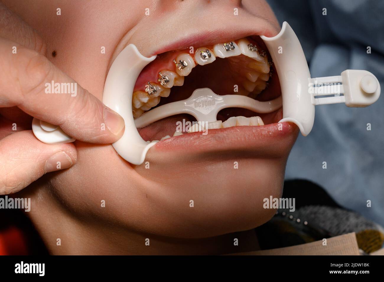 Primo piano del paziente con il divaricatore della guancia in bocca che  mostra le bretelle dentali sui denti bianchi. Donna con staffe ortodontiche  cablate in visita alla clinica dentale. Concetto di trattamento