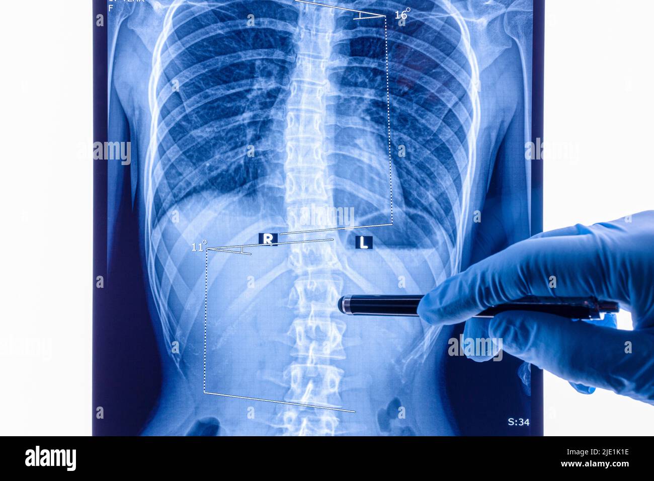 Il medico analizza i raggi X della colonna vertebrale che mostrano scoliosi nell'area lombare. La scoliosi è una curvatura laterale anomala della colonna vertebrale. Foto Stock