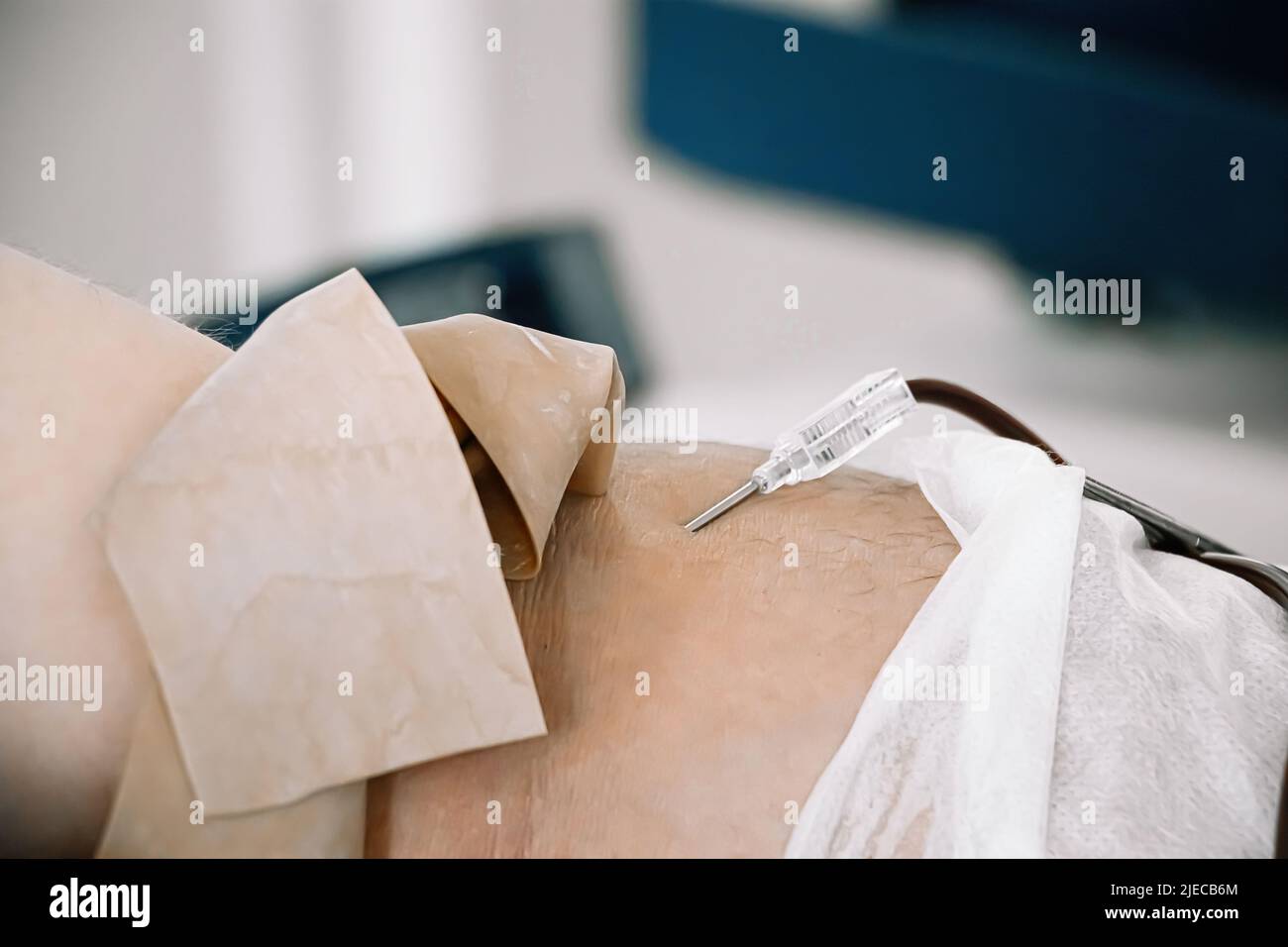 Catetere in primo piano in vena. Giornata internazionale della donazione di sangue. Il donatore dona sangue per salvare la vita. Trasfusione di sangue in laboratorio medico. Foto Stock