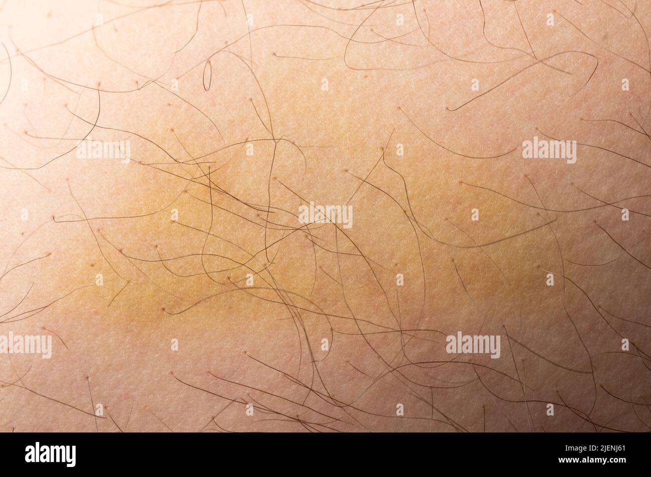 Ferire la pelle delle gambe con vista ravvicinata macro lividi Foto Stock