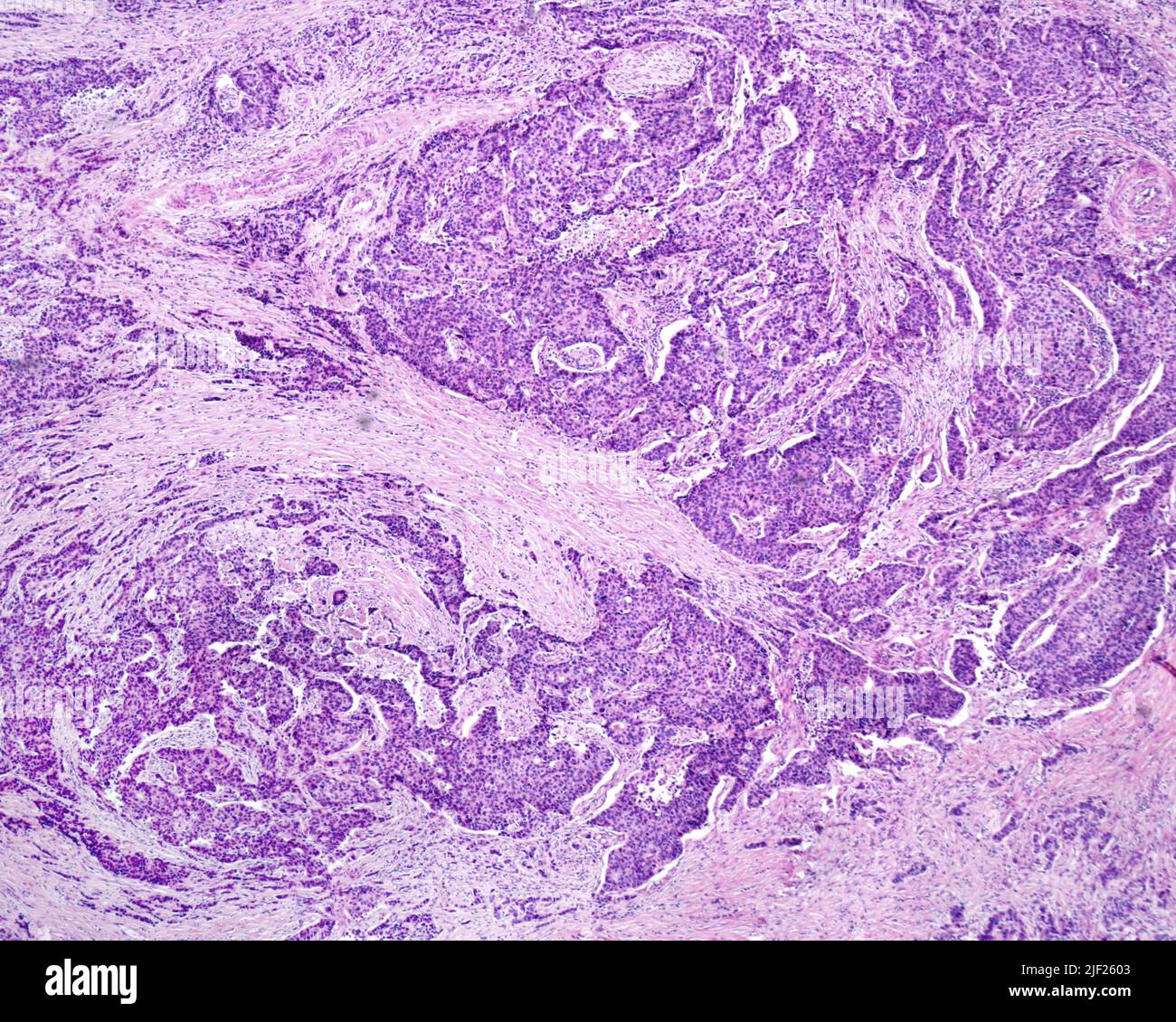 Adenocarcinoma gastrico, micrografia leggera. L'adenocarcinoma gastrico è un tumore epiteliale maligno (canceroso), originato dall'epitelio ghiandolare della mucosa gastrica. I tumori dello stomaco sono circa il 90% degli adenocarcinomi e la terza causa di morte per cancro. Qui si vedono corde di cellule tumorali epiteliali che infiltrano lo strato muscolare della parete dello stomaco. Foto Stock