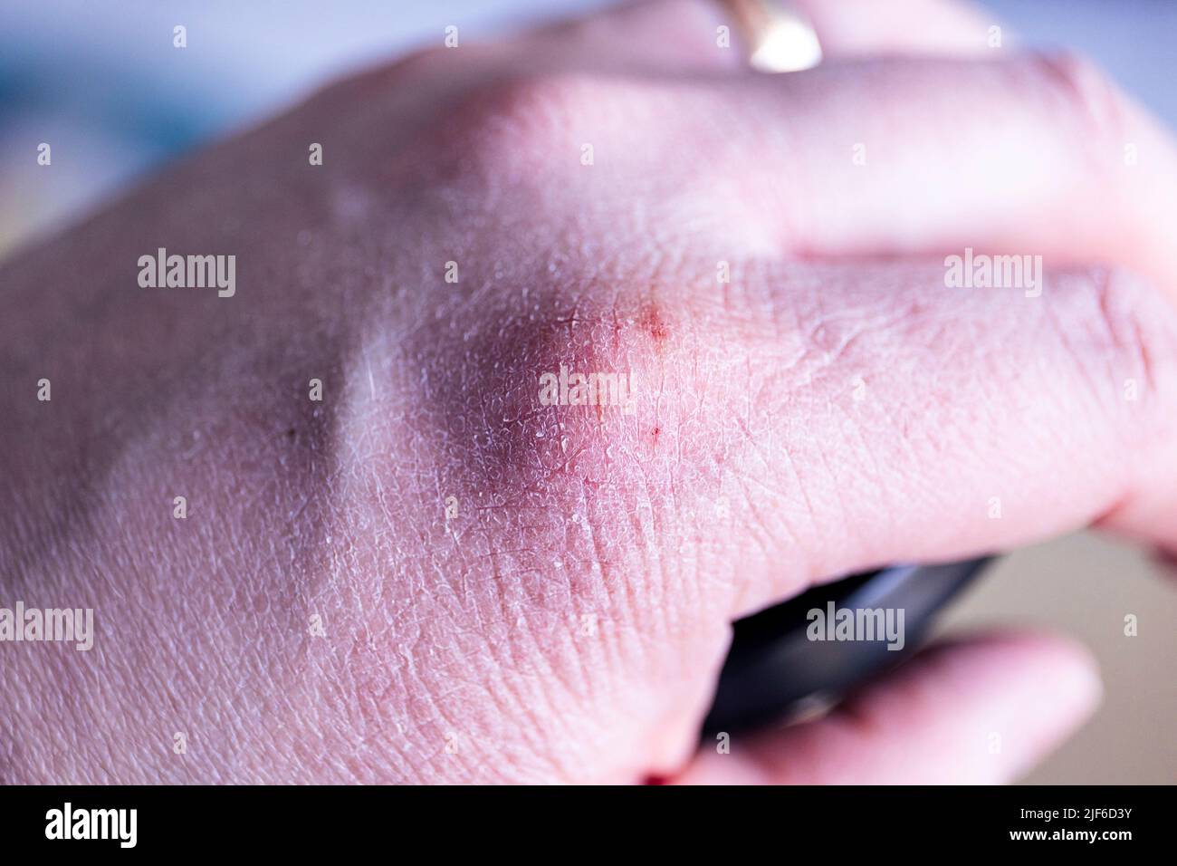 Un ritratto di una mano con pelle asciutta con alcune fessure dolorose in esso. La pelle incrinata deve essere trattata con unguento o crema idratante per pr Foto Stock