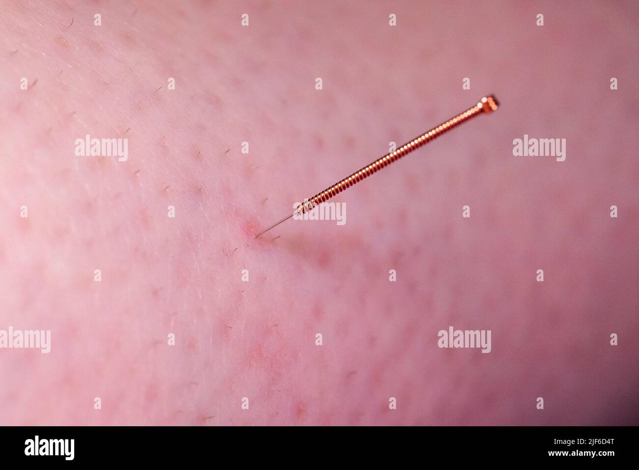 Un piccolo ago di agopuntura che si attacca nella pelle di un paziente. L'ago ha una presa di rame ed è perforato in profondità nella pelle per alleviare lo stress e. Foto Stock