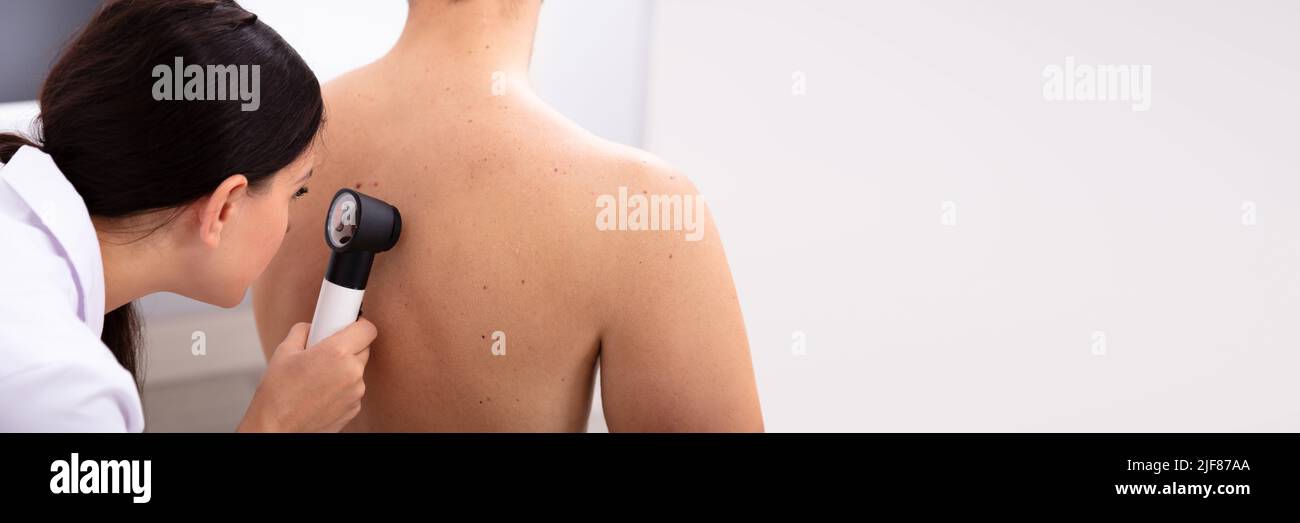 Medico donna esaminando la pelle pigmentata all uomo la schiena con Dermatoscope Foto Stock