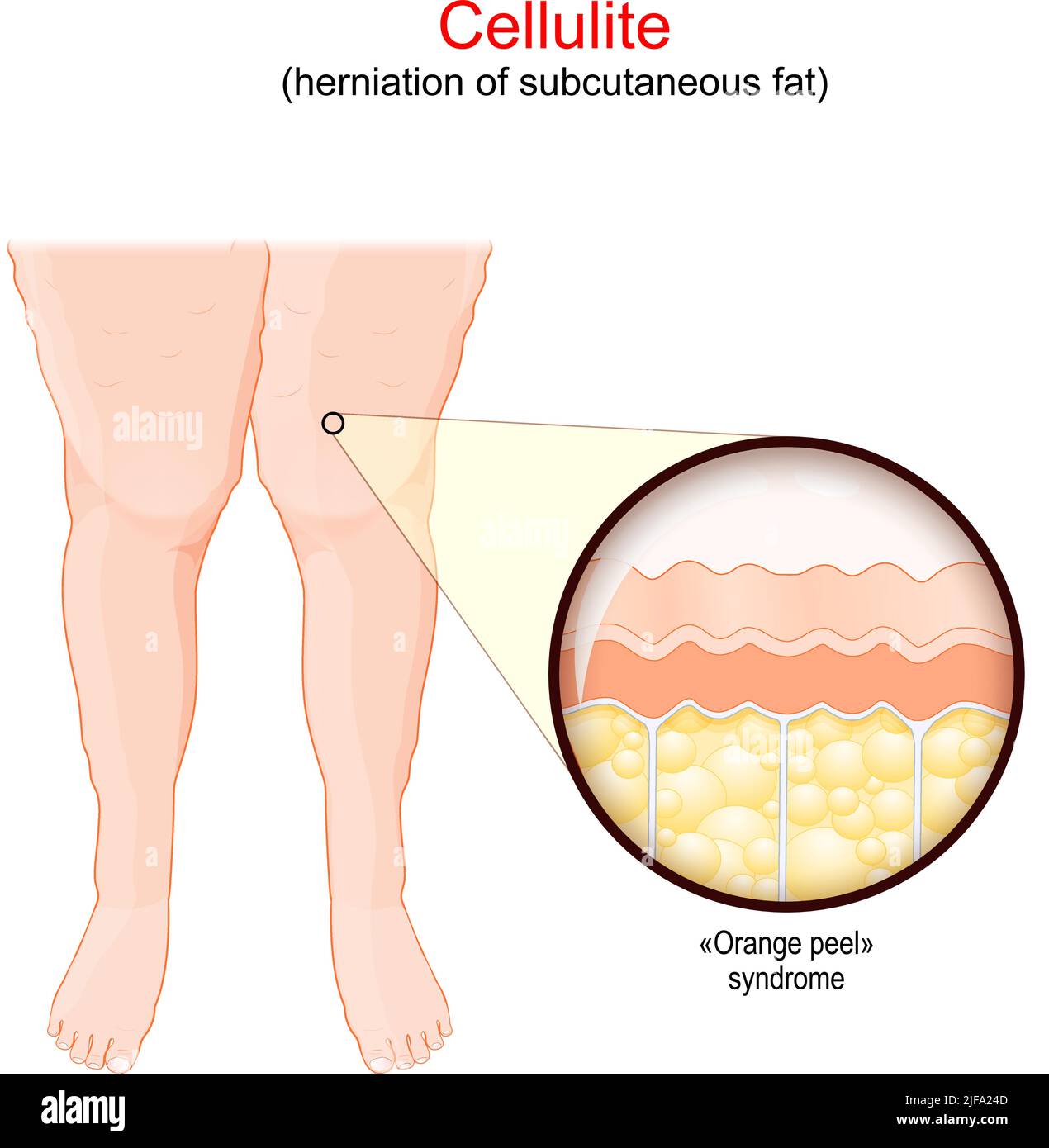 Cellulite. Femmine gambe con adiposis edematosa. Primo piano di una pelle umana con sindrome da buccia d'arancia. Herniation di grasso sottocutaneo. Vettore Illustrazione Vettoriale