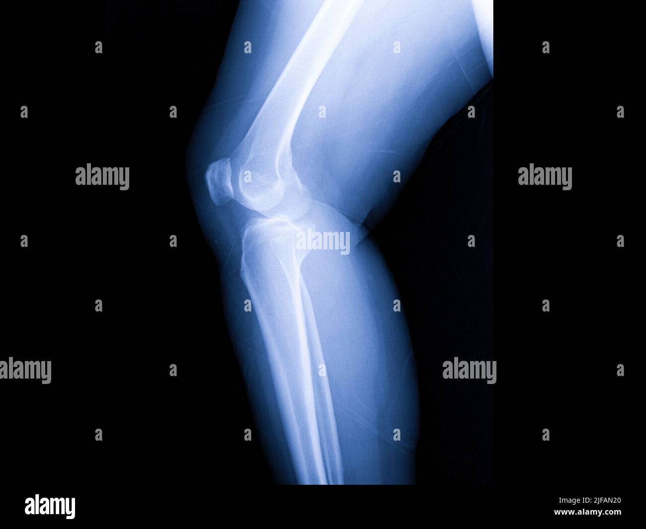 immagine radiologica di entrambe le articolazioni del ginocchio umano Foto Stock