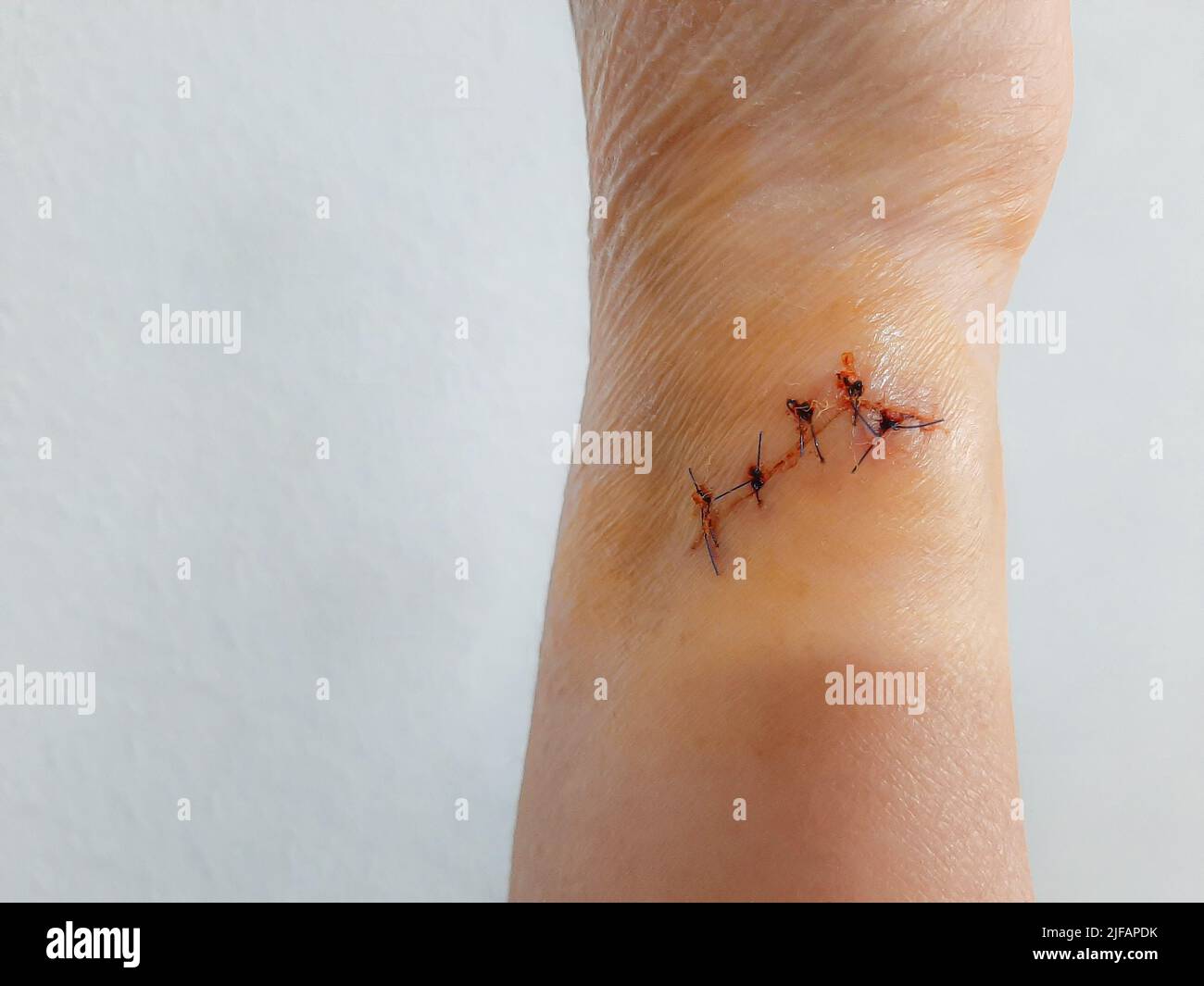 Ferite e punti sul braccio di una paziente anziana, incidenti domestici, assistenza agli anziani a casa Foto Stock