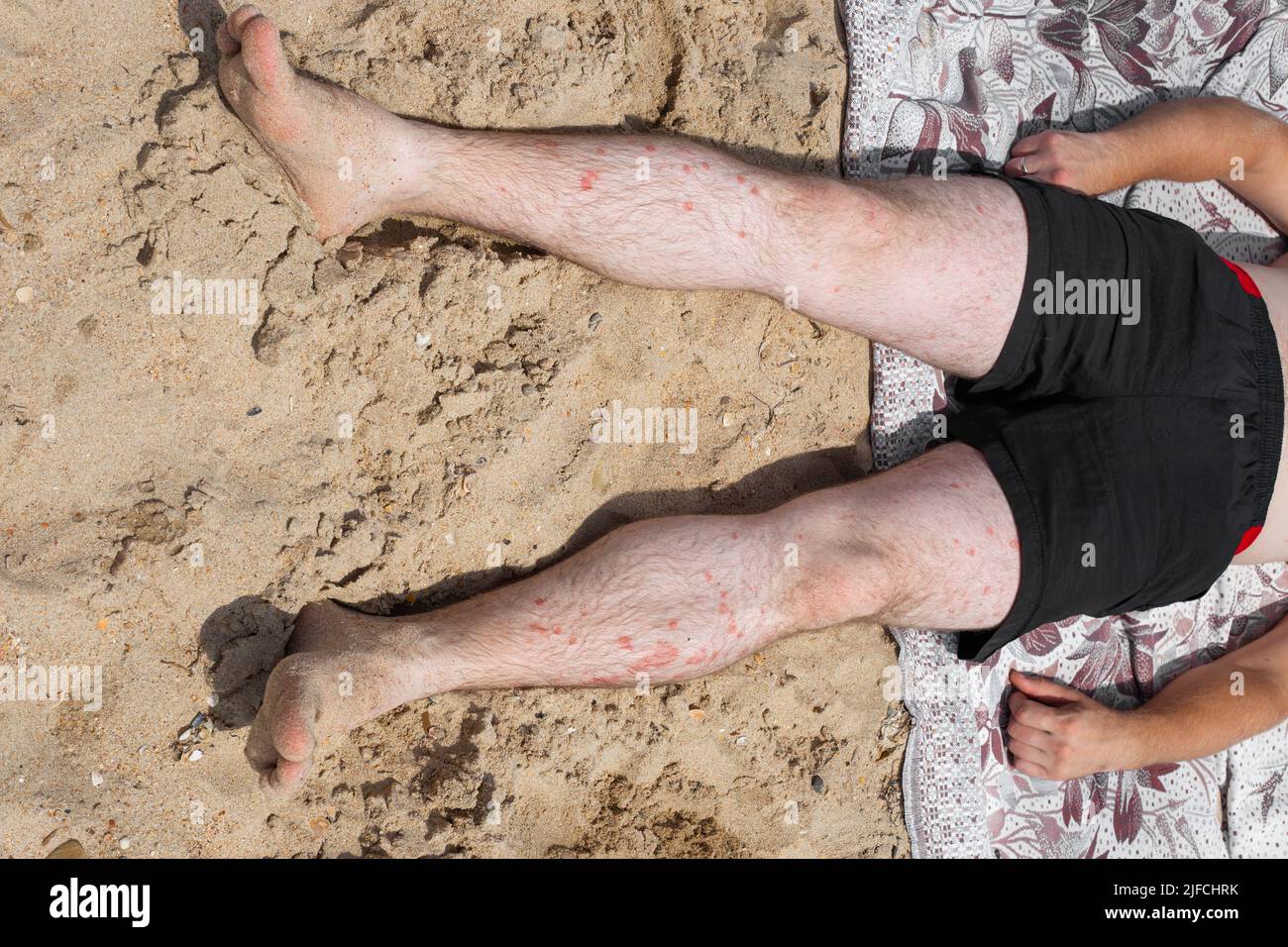 Un uomo adulto che prende il sole si trova sulla sabbia con gambe pallide con macchie rosse di psoriasi. Malattia della pelle con ulcere psoriasiche. Foto Stock