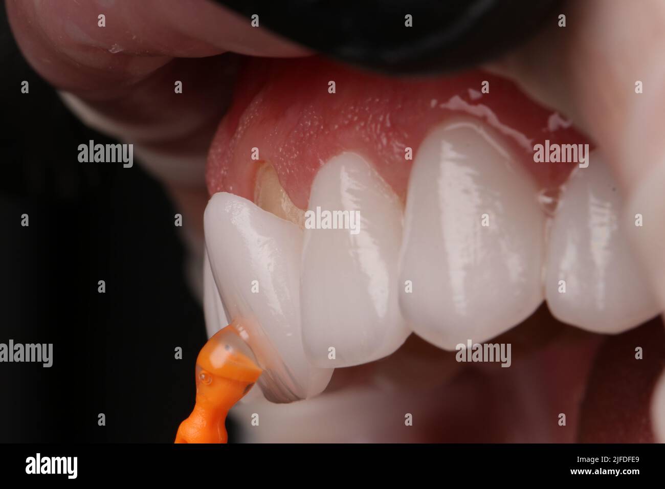 In questa foto si possono vedere i laminati e-max, completamente estetici, realizzati da dentisti. Foto Stock