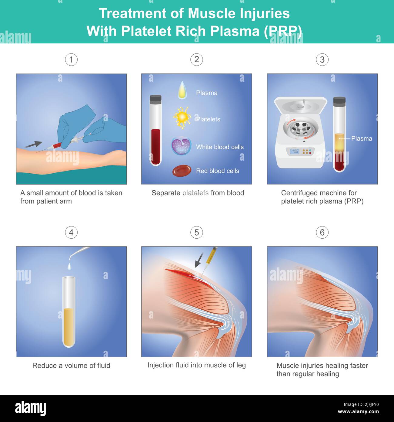 Trattamento delle lesioni muscolari con plasma ricco di piastrine. Diagramma trattamento di lesioni muscolari un ginocchio da piastrine di sangue un paziente. Illustrazione Vettoriale