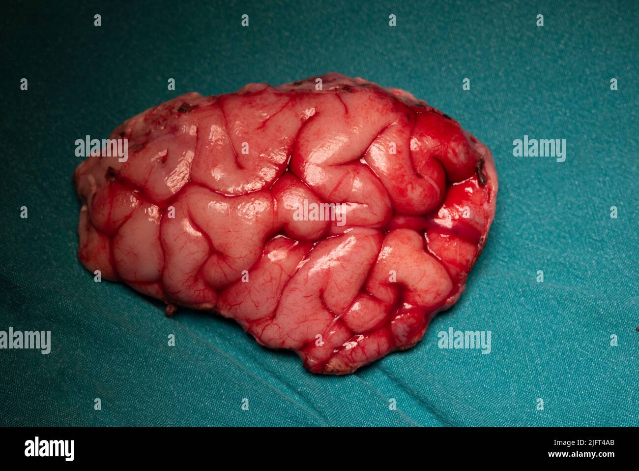 Campione chirurgico di cervello al lobo frontale che causa convulsioni sul tavolo verde Foto Stock
