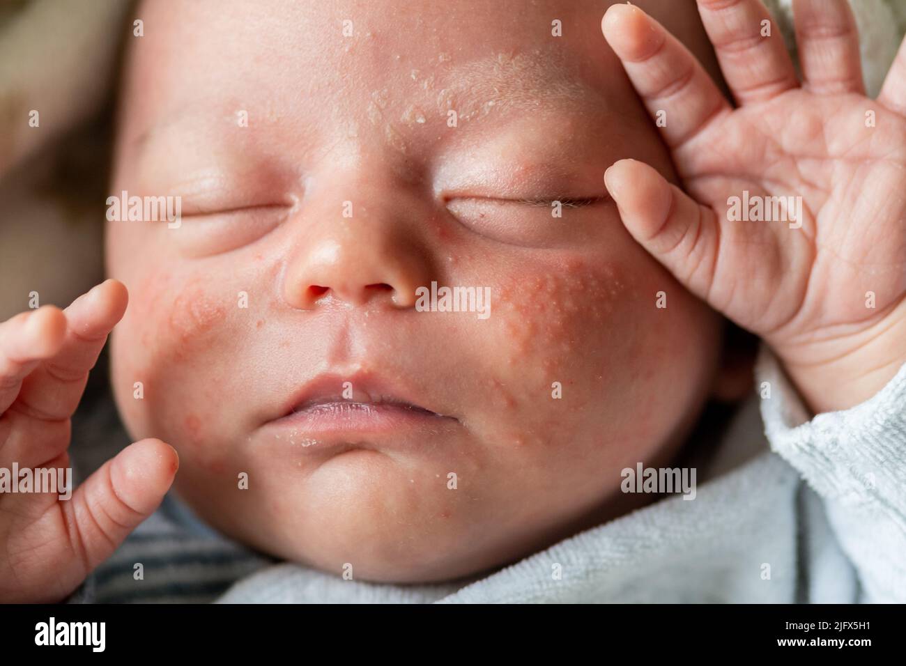 bambino faccia il bambino con acne di milia, engordaderas, accumuli di cheratina Foto Stock