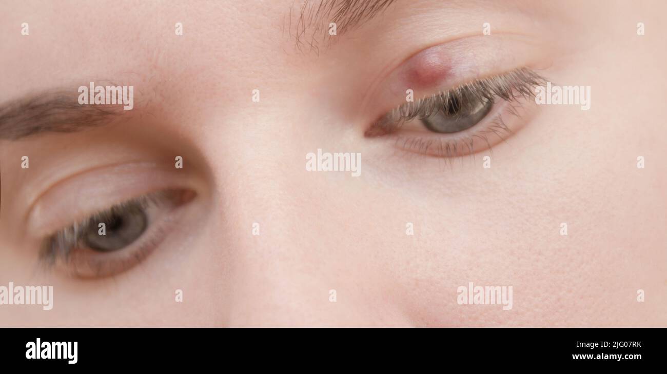 Coperchio dell'occhio rosso doloroso con inizio di infezione da stye dovuta. Primo piano di una giovane donna con occhio blu con infezione da stye. Foto Stock
