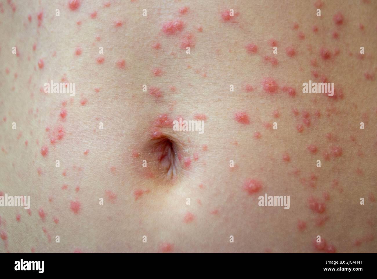 Virus della varicella o eruzione cutanea da bolle di varicella nel bambino Foto Stock