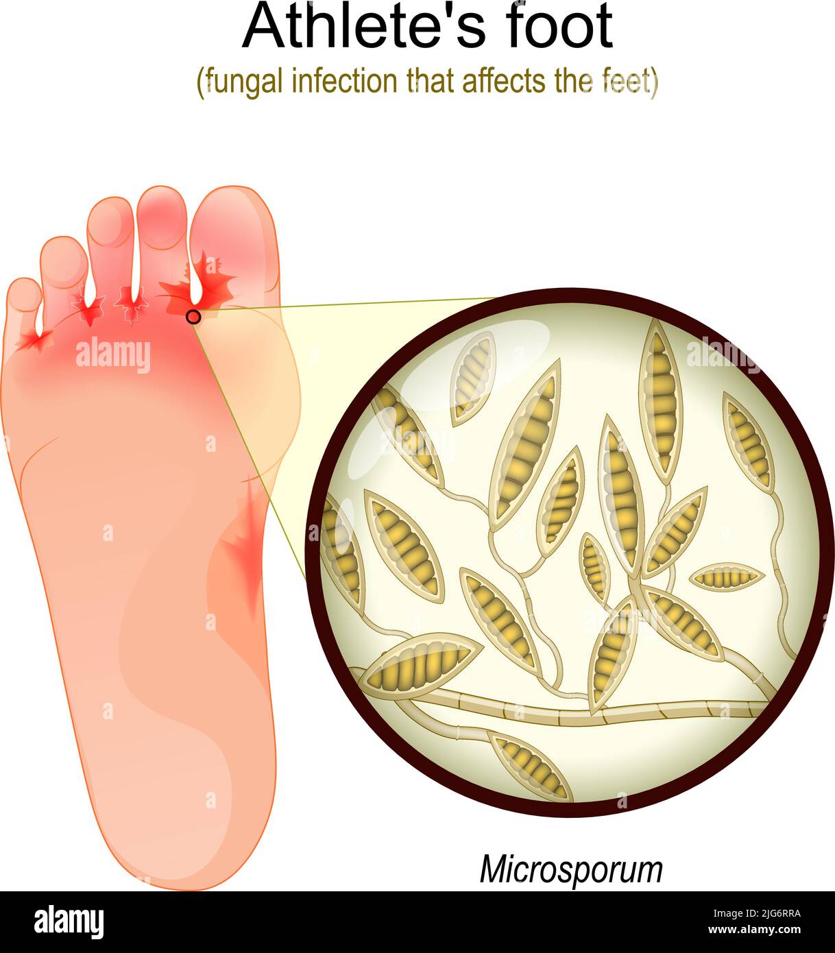 Piede dell'atleta. Infezione fungina che colpisce i piedi. Primo piano del lievito che causa la malattia di infezione della pelle. Microsporum. Illustrazione vettoriale Illustrazione Vettoriale