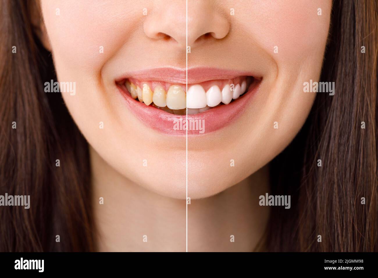 Donna sorridente prima e dopo la procedura di sbiancamento dei denti, immagine close-up. Foto Stock