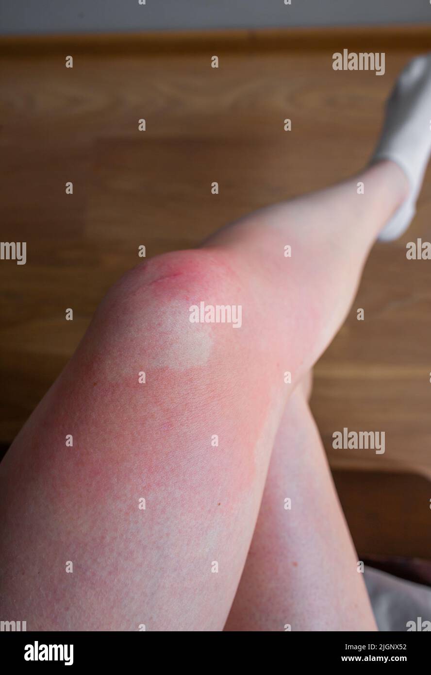Primo piano di ustione sulla gamba seduta donna caucasica gamba con primo grado ustione pelle bruciare la pelle rossa dopo ustione primo piano Foto Stock