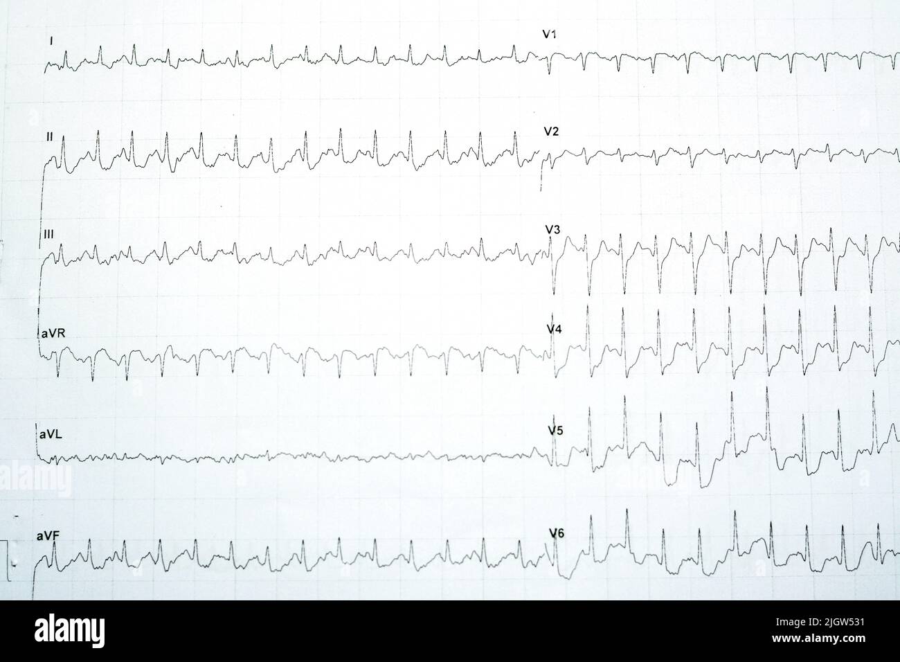 Un'ischemia miocardica indotta da stress positiva con significative variazioni orizzontali del sottoslivellamento del tratto ST nel test elettrocardiografico ECG da stress, Patient WAS Foto Stock