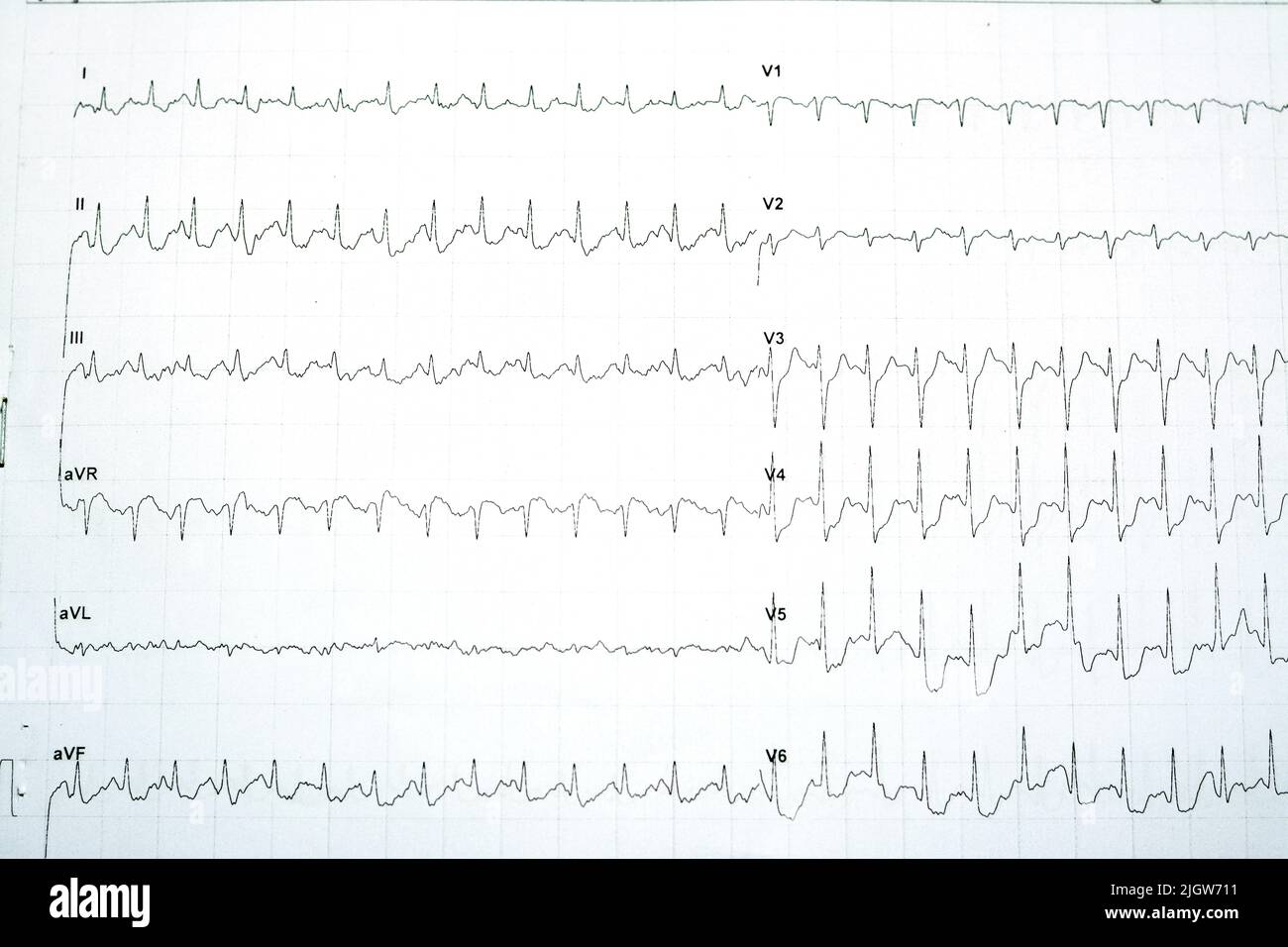 Prova di sforzo dell'elettrocardiogramma immagini e fotografie stock ad  alta risoluzione - Alamy