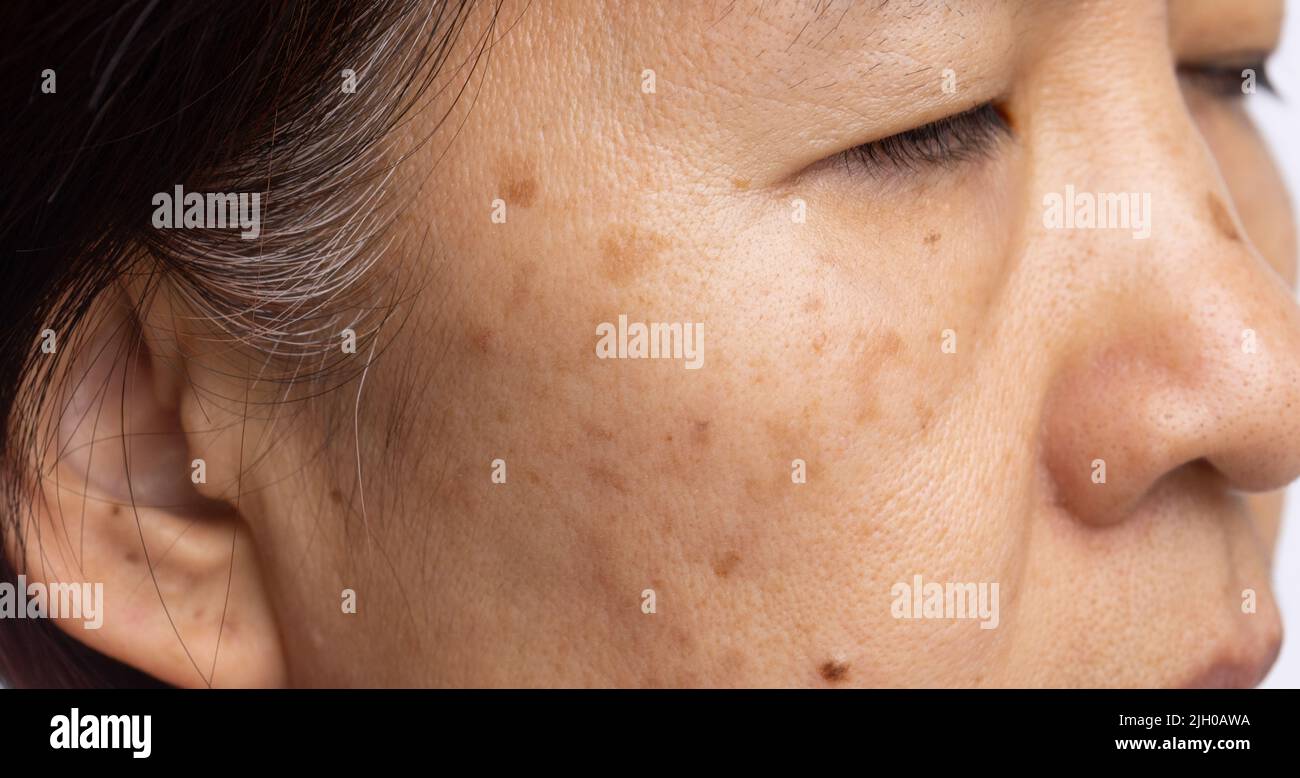 Le donne in menopausa si preoccupano del melasma sul viso. Foto Stock