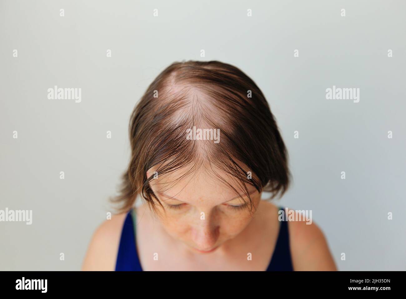 Perdita di capelli sotto forma di alopecia areata. Testa calva di una donna. Diradamento dei capelli dopo il covid. Cerotti calvo di alopecia totale Foto Stock