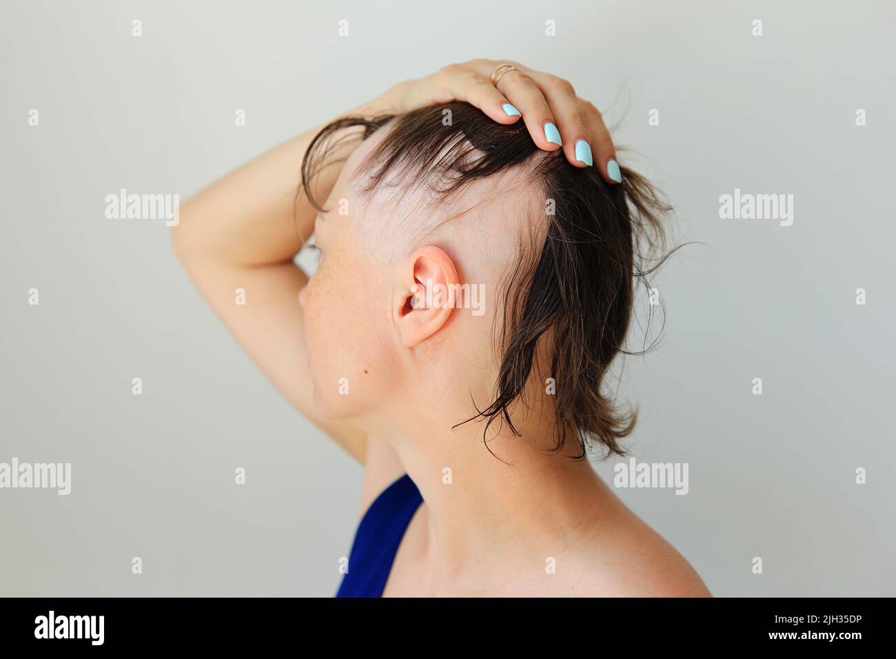Perdita di capelli sotto forma di alopecia areata. Testa calva di una donna. Diradamento dei capelli dopo il covid. Cerotti calvo di alopecia totale Foto Stock