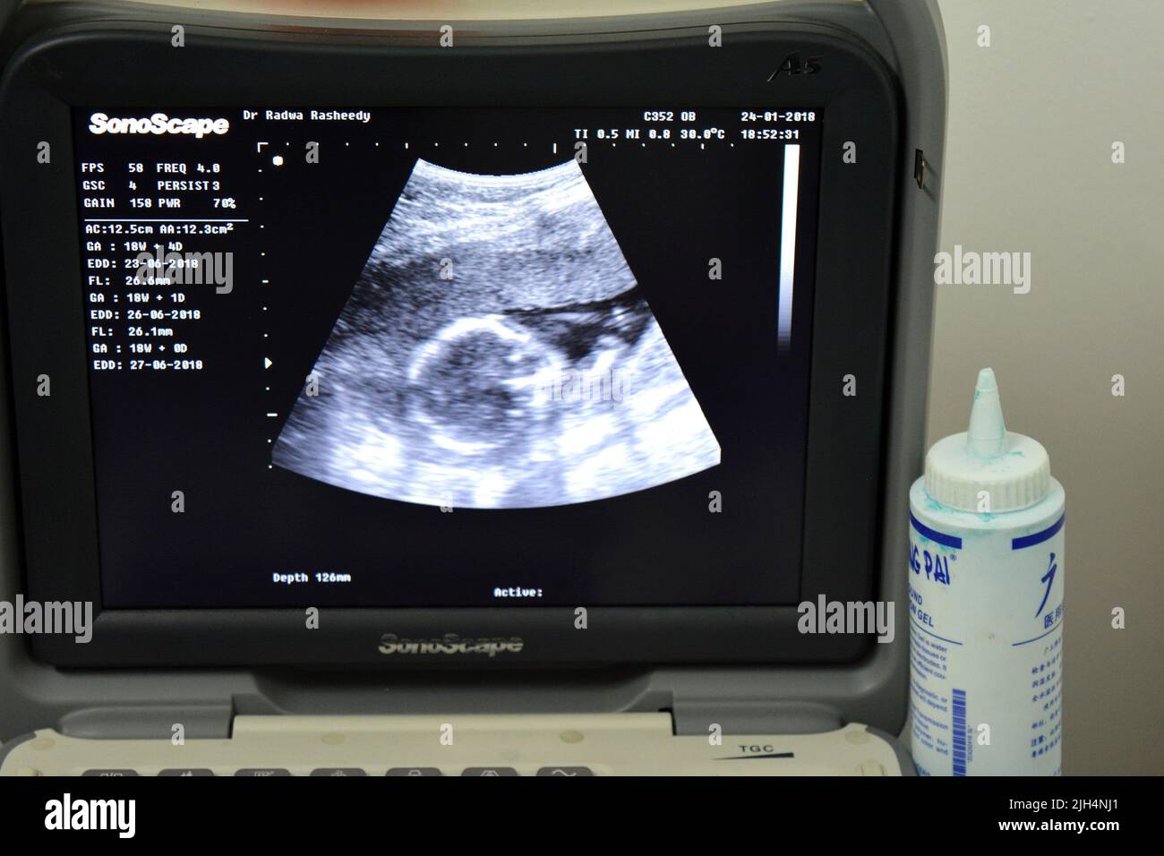 Cairo, Egitto, gennaio 24 2018: Un monitor di un'ecografia portatile che mostra la testa di un feto con un GA di età gestazionale 18 settimane e 4 giorni di durata Foto Stock