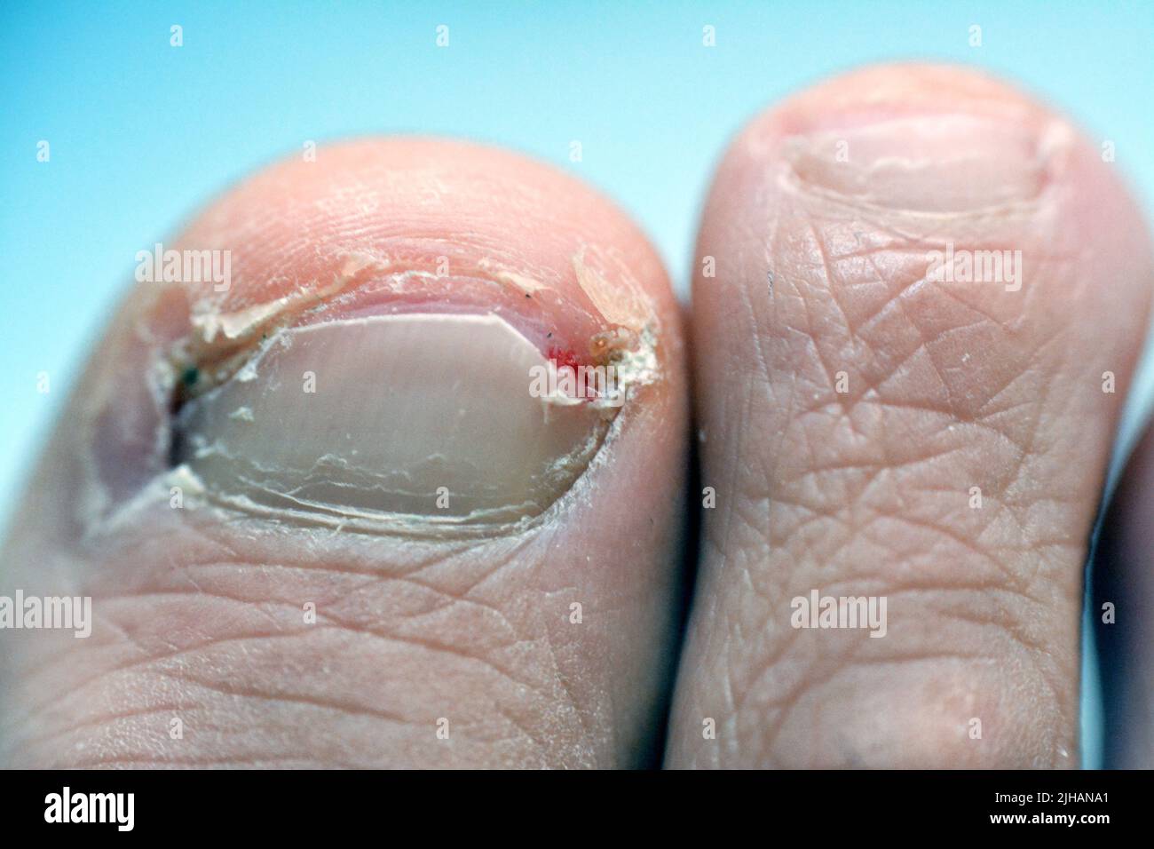 Il toenail ingrown della punta grande del piede di destra è una condizione comune in cui l'angolo o il lato di un toenail cresce nella carne molle risultato in pa Foto Stock