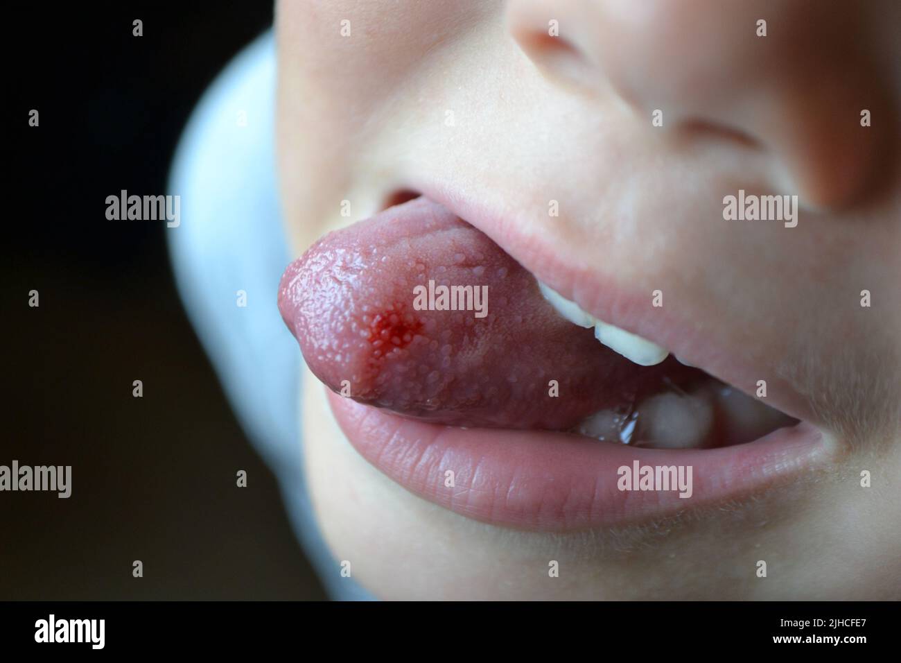 Lingua morso del bambino. Primo piano di labbra, lingua, protrusione di sangue Foto Stock