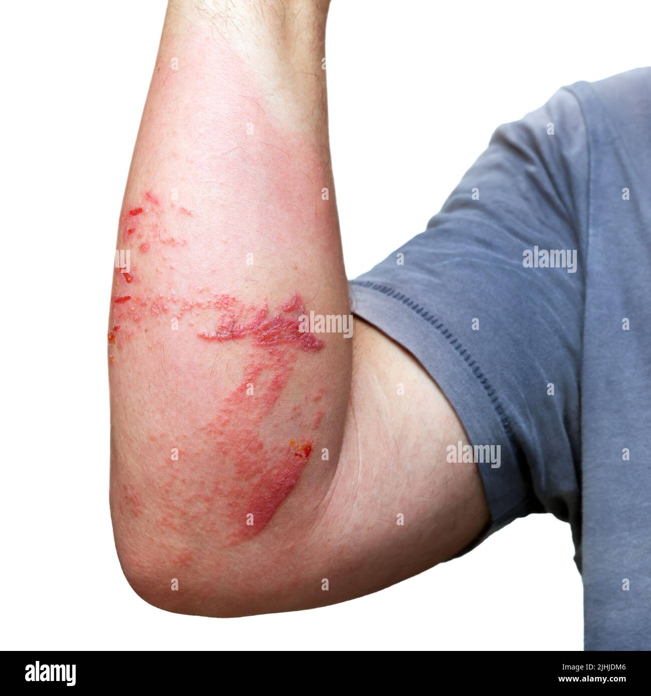 Braccio maschio con ustioni cutanee e lesioni causate da meduse isolate su bianco Foto Stock