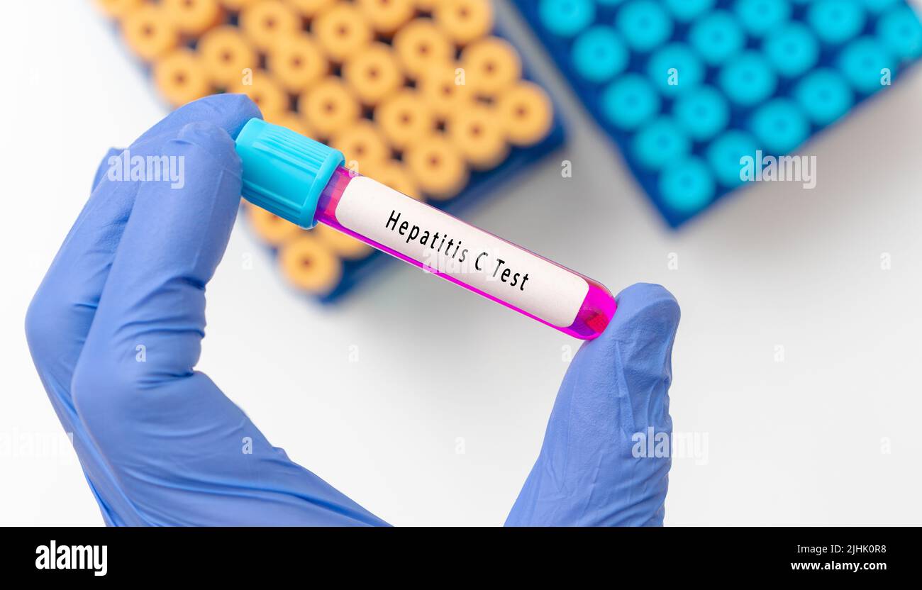 Risultato del test del virus dell'epatite C (HCV) con campione di sangue in provetta per analisi a portata di medico in laboratorio medico Foto Stock