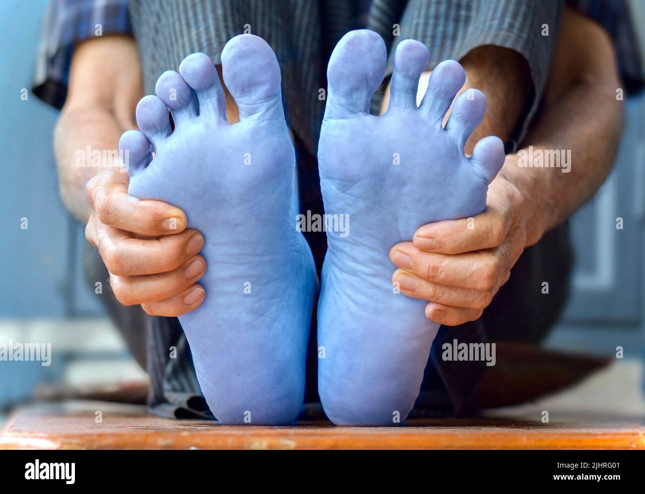 Piedi di colore blu chiaro dell'anziano asiatico. Concetto di piede freddo e argumoso. Foto Stock