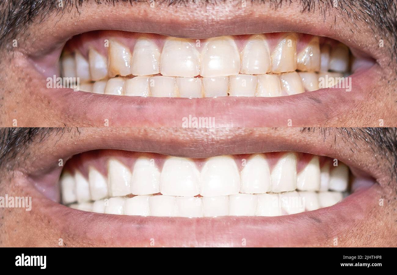 Primo piano dei denti di Un uomo sorridente prima e dopo lo sbiancamento Foto Stock