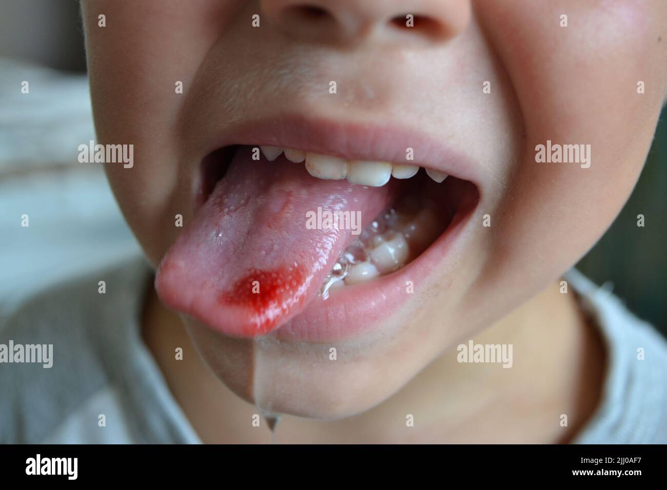Lingua morso del bambino. Primo piano di labbra, lingua, protrusione di sangue Foto Stock