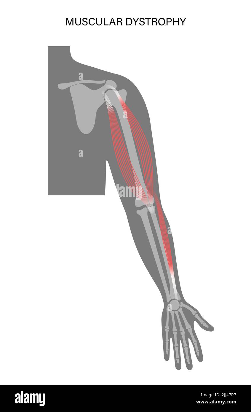 Distrofia muscolare, illustrazione. Foto Stock
