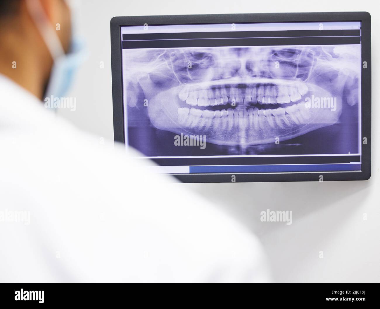 Sembra che sia necessario fare un'estrazione. Un dentista che analizza una radiografia dei denti di un paziente. Foto Stock