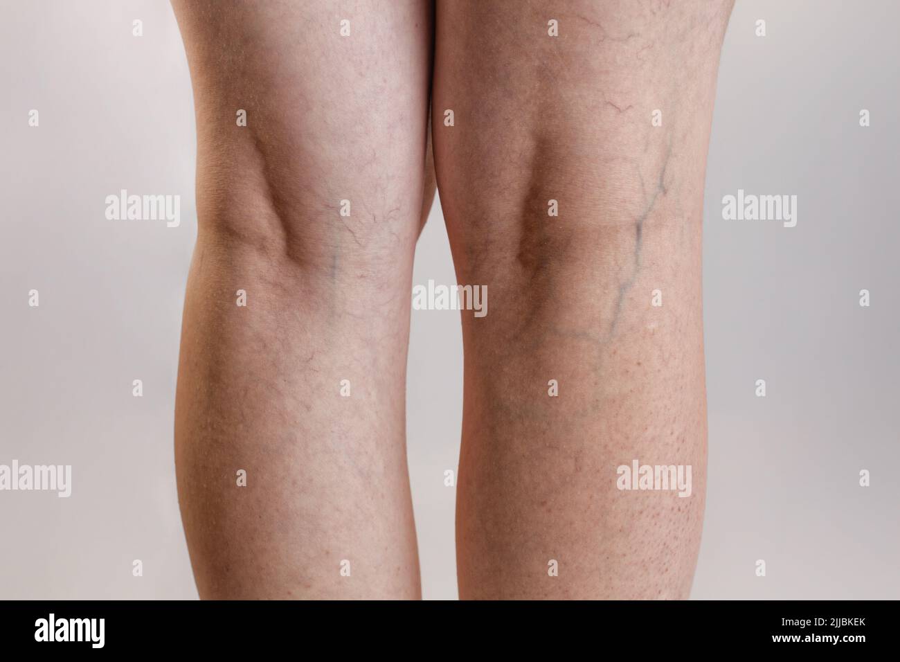 Vene varicose e medicina. Le gambe femminili si chiudono - su con i vasi e la fase iniziale della malattia di varicose. Foto Stock